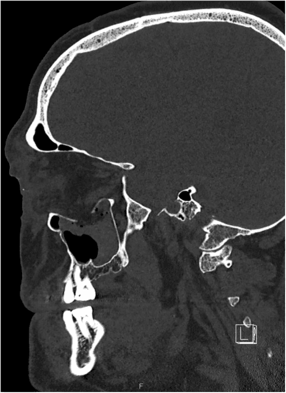 **Imaging Modality:** Computed Tomography (CT), bone window setting.
**Anatomical Region:** Midface and neurocranium, sagittal reformatted view.
**Observed Pathology:** Extended orbital floor blowout fracture. The image displays a significant disruption and inferior displacement of the bony orbital floor into the underlying maxillary sinus. There is an associated herniation of orbital soft tissue (extraconal fat and potentially the inferior rectus muscle) into the superior aspect of the maxillary antrum.
**Characteristic Visual Features:**
- **Osseous Findings:** Comminuted fracture of the floor of the orbit with a large bony defect.
- **Soft Tissue Findings:** "Teardrop sign" or trapdoor-type appearance where orbital contents prolapse through the fracture site.
- **Secondary Features:** Partial opacification of the maxillary sinus, likely representing hemosinus or displaced soft tissue. The anterior and posterior walls of the maxillary sinus appear grossly intact in this plane, localizing the primary trauma to the orbital interface.
**Diagnostic Features:** These findings are characteristic of a high-energy "blowout" mechanism, frequently resulting in globe displacement or entrapment of extraocular muscles. The visualization of the defect in the sagittal plane confirms the anteroposterior extent of the orbital floor involvement.