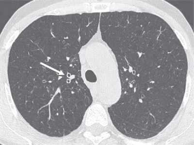**Imaging Modality:** High-resolution thin-section computed tomography (HRCT) of the chest.
**Anatomical Region:** Axial section at the level of the upper lobes and the trachea.
**Observed Pathology:** Chronic Obstructive Pulmonary Disease (COPD) with associated chronic bronchitis and early-stage emphysema.
**Characteristic Visual Features:**
* **Bronchial Wall Thickening:** There is visible thickening of the segmental and subsegmental bronchial walls (indicated by the white arrow). These appear as prominent "ring shadows" when visualized in cross-section, reflecting airway inflammation and remodeling.
* **Parenchymal Changes:** Small, scattered areas of low attenuation (lucency) without visible walls are distributed in a centrilobular pattern throughout the lung parenchyma, consistent with early centrilobular emphysema.
* **Vascular Markings:** Peripheral pulmonary vasculature remains present but is set against a background of mildly decreased lung attenuation.
**Key Diagnostic Features:** The combination of thickened bronchial walls and centrilobular lucencies in a patient with a smoking history is highly characteristic of the airway-predominant and parenchymal-destructive phenotypes of COPD. These findings differentiate the condition from pure bronchiectasis or asthma, which typically lack the centrilobular destructive component.