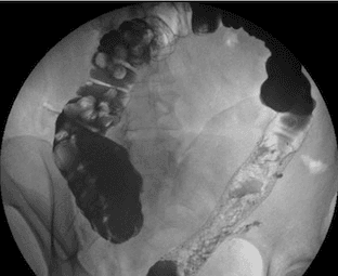 **Modality:** Single-contrast fluoroscopic barium enema.
**Anatomic Region:** Abdomen and pelvis, specifically the lower gastrointestinal tract including the rectum and sigmoid colon.
**Observed Findings:**
The image demonstrates a significant contrast-enhanced segment of the distal colon. The rectum and distal sigmoid colon exhibit a diffuse, "lead-pipe" appearance characterized by a complete loss of normal haustral markings. The mucosal surface appears irregular with fine ulcerations or a "granular" texture, suggestive of chronic inflammatory changes. In contrast, the more proximal colonic segments (visible in the upper left) retain more recognizable haustral patterns but appear distended. There is no evidence of immediate mechanical obstruction or gross perforation in this view.
**Diagnostic Features:**
* **Ahaustral Colon:** Loss of haustrations in the descending/sigmoid region, a classic sign of chronic ulcerative colitis.
* **Mucosal Granularity:** Suggestive of active inflammatory bowel disease (IBD).
* **Tubular Configuration:** Narrowing and shortening of the bowel segment.
**Clinical Significance:** These radiologic findings are highly characteristic of chronic ulcerative colitis with distal involvement. The image is suitable for indexing under inflammatory bowel disease (IBD), barium enema findings, and chronic colonic inflammation.