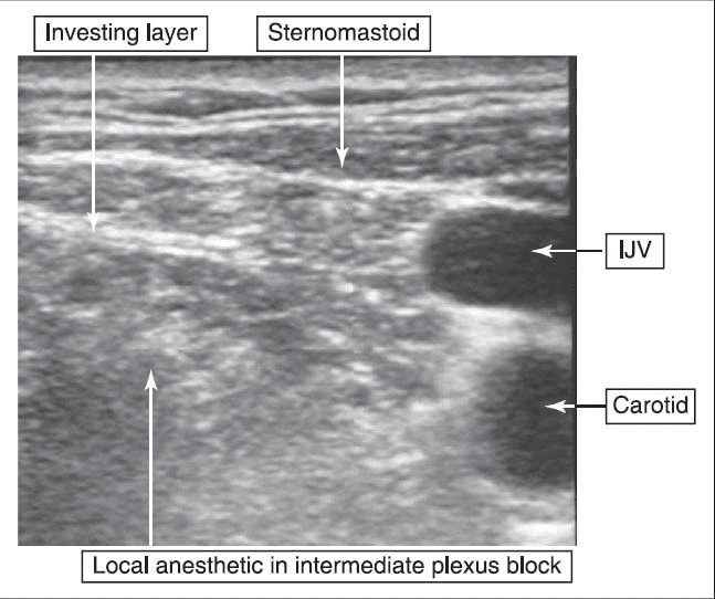**Imaging Modality:** Ultrasound (B-mode)
**Anatomical Region:** Lateral cervical region (neck)
**Key Landmarks:**
* **Musculature:** Sternocleidomastoid muscle (labeled as sternomastoid) positioned superficially.
* **Vasculature:** Internal Jugular Vein (IJV) and Carotid Artery, visualized as anechoic circular structures on the right aspect of the frame.
* **Fascial Layers:** The investing layer of the deep cervical fascia is identified.
**Procedural Findings:**
The image demonstrates an intermediate cervical plexus block. A hypoechoic collection of local anesthetic is visible deep to the investing fascia of the neck and the sternocleidomastoid muscle, but superficial to the prevertebral fascia. The fluid distribution is noted surrounding the cervical plexus nerves, lateral to the vascular bundle (IJV and carotid).
**Diagnostic/Visual Features:**
The ultrasound captures the hydrodissection of fascial planes. The contrast between the hyperechoic fascial lines and the hypoechoic local anesthetic fluid confirms appropriate needle placement for a regional anesthesia technique targeting the intermediate cervical plexus.