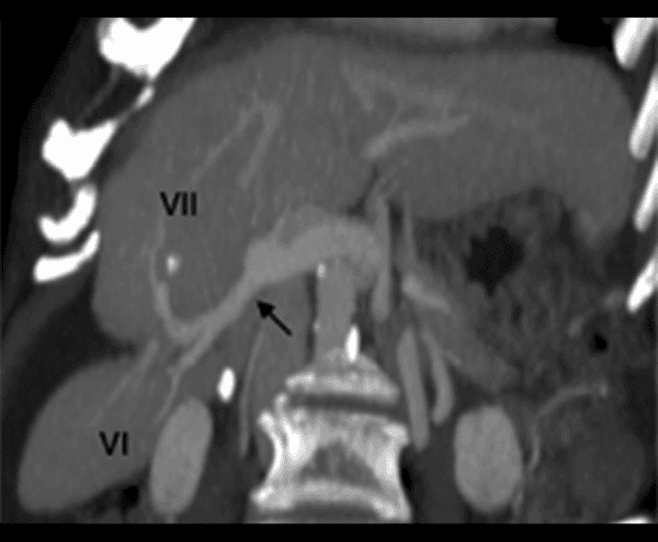 **Imaging Modality:** Computed Tomography (CT), Maximum Intensity Projection (MIP) reconstruction.
**Anatomical Region:** Abdomen, specifically focusing on the hepatobiliary system and the right lobe of the liver.
**Key Landmarks and Vascular Anatomy:**
The image displays the portal venous anatomy within the right hepatic lobe. A prominent right posterior sectorial branch of the portal vein (indicated by a black arrow) is visible, originating from the main portal vein. This branch bifurcates to supply Segment VI (inferiorly) and Segment VII (superiorly). The segmental venules are clearly delineated as they penetrate the hepatic parenchyma.
**Observed Pathology/Anatomy:**
The image highlights a deep parenchymal cleft or indentation through which the posterior sectorial branch travels. The Couinaud segments VI and VII are labeled, demonstrating the typical distribution of the portal venous supply to the posterior sector of the liver.
**Diagnostic Features:**
The use of MIP enhancement facilitates the visualization of vascular continuity and branching patterns against the liver parenchyma. This serves as a primary reference for segmental hepatic anatomy and preoperative planning for liver resection or transplant evaluation.