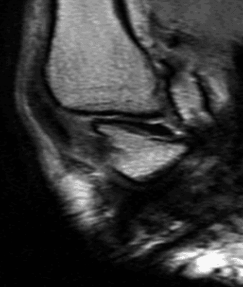 **Imaging Modality:** Magnetic Resonance Imaging (MRI).
**Anatomical Region:** Oblique view of the first carpometacarpal (CMC) joint of the hand.
**Key Landmarks and Features:**
- **Primary Structure:** The anterior oblique ligament (AOL), also known as the beak ligament, is visualized extending from the volar tubercle of the trapezium to the volar base of the first metacarpal.
- **Orientation:** The image captures an oblique plane specifically angled to isolate the longitudinal fibers of the AOL.
- **Markers:** A high-signal external marker is positioned adjacent to the skin surface, corresponding to the anatomical location of the ligament for localization purposes.
- **Joint Characteristics:** The saddle-shaped articulation between the trapezium and the base of the first metacarpal is visible. The ligament appears as a low-signal (hypointense) band, providing essential stability to the CMC joint.
**Clinical Significance:** This view is utilized to assess the integrity of the primary stabilizing structures of the thumb base. It is critical for evaluating ligamentous laxity, attenuation, or tearing associated with first CMC joint instability or basal joint osteoarthritis.