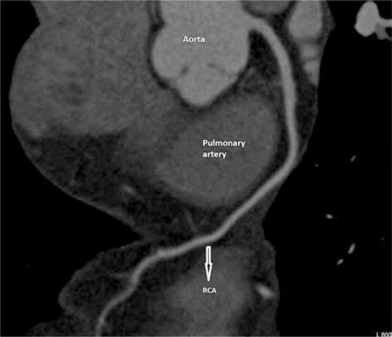 **Imaging Modality:** Computed Tomography Angiography (CTA), presented as a Maximum Intensity Projection (MIP) reconstruction of the heart and great vessels.
**Anatomical Region:** Thorax, focusing on the aortic root and coronary arteries.
**Observed Pathology:** Anomalous origin of the right coronary artery (RCA).
**Characteristic Visual Features:**
The image demonstrates the RCA arising anomalously from the left coronary sinus of the aorta, rather than the right sinus. The vessel follows an "interarterial course," passing acutely between the ascending aorta and the main pulmonary artery. Annotated labels identify the aorta and pulmonary artery, with an arrow highlighting the RCA as it traverses the space between these two major vessels before descending into the right atrioventricular groove.
**Key Diagnostic Features:**
- **Origin:** Left coronary sinus.
- **Course:** Malignant/interarterial trajectory, which carries a risk of compression during exercise or increased cardiac output.
- **Morphology:** Visible narrowing or "slit-like" appearance at the ostium and proximal segment as it passes between the great vessels.
**Clinical Context:** This is a classic representation of a high-risk coronary anomaly (Anomalous Aortic Origin of a Coronary Artery - AAOCA) visualized via cardiac CT for surgical planning or risk stratification.