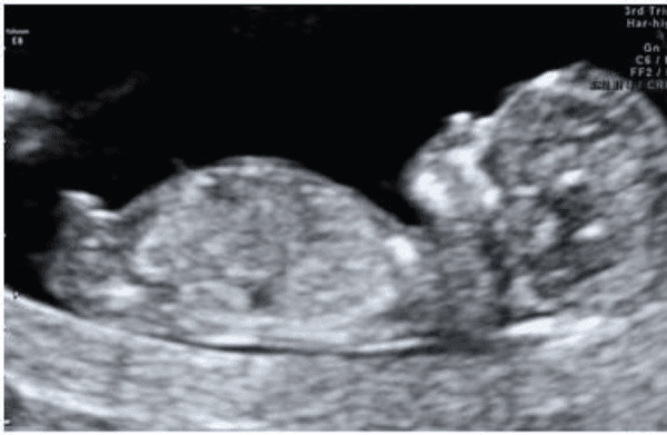 **Imaging Modality:** Obstetric Ultrasound (2D grayscale).
**Anatomical Region:** Intrauterine environment showing a single fetus in a mid-sagittal plane.
**Clinical Context:** First-trimester screening, approximately 12–13 weeks gestation.
**Key Visual Features:**
* **Fetal Anatomy:** The image captures the fetus in a profile view, demonstrating the head (cranium), thorax, and abdomen. The fetal spine is visible along the lower aspect of the trunk.
* **Cranial Structures:** Early ossification of the skull is evident. The nasal bone and facial profile are distinguishable.
* **Nuchal Region:** The nuchal translucency (NT) space—the sonographic appearance of subcutaneous fluid behind the fetal neck—is visible for assessment.
* **Genitourinary Markers:** A prominent genital tubercle (phallus) is visualized at the caudal end of the torso. The cranial orientation of the tubercle (angle relative to the lumbosacral spine) is a sonographic marker used for early fetal sex determination, suggesting male development.
* **Environment:** The fetus is surrounded by anechoic amniotic fluid, providing clear visualization of the fetal borders.
**Diagnostic Significance:** This plane is critical for assessing crown-rump length (CRL), nuchal translucency thickness, and early anatomical surveys including the presence of the nasal bone and genital tubercle orientation.