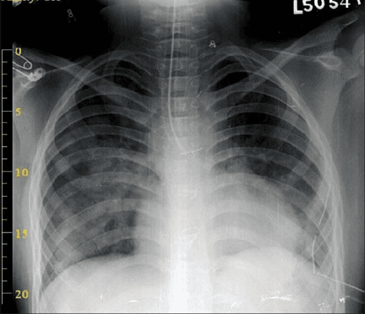 **Imaging Modality:** Anteroposterior (AP) chest radiograph (X-ray).
**Anatomical Region:** Thorax, including the trachea, mainstem bronchi, and bilateral lung fields.
**Observed Pathology/Findings:**
- **Medical Devices:** A double-lumen endotracheal tube (DLT) is in situ. The distal tip is positioned within the left mainstem bronchus, consistent with a left-sided DLT placement for lung isolation.
- **Pulmonary Parenchyma:** The right lung field demonstrates clear aeration with preserved transparency. In contrast, the left lower lung zone exhibits increased radiopacity and hazy consolidation, suggestive of atelectasis or reduced ventilation in the isolated lung.
- **Mediastinum:** The cardiomediastinal silhouette appears stable; the trachea is midline.
- **Pleural Space:** No overt evidence of pneumothorax or large pleural effusion is visualized.
**Key Diagnostic Features:**
The primary diagnostic feature is the visualization of the radiopaque markers of the double-lumen tube confirming endobronchial intubation. The differential aeration between the right and left lungs highlights the functional status of one-lung ventilation or post-procedural re-expansion.
**Clinical Classification:**
Post-intubation imaging; thoracic anesthesia monitoring; lung isolation verification.