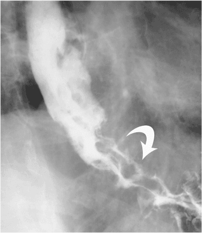**Imaging Modality:** Fluoroscopic contrast study (Esophagram/Barium Swallow).
**Anatomical Region:** Distal esophagus and gastroesophageal junction.
**Observed Pathology:** Varicoid carcinoma of the distal esophagus.
**Characteristic Visual Features:** The image demonstrates multiple, prominent serpiginous and longitudinal filling defects within the contrast-filled esophageal lumen. These defects create a tortuous, "cobblestone" or "worm-like" appearance, highlighted by a curved white arrow in the distal segment. Unlike traditional esophageal varices, these findings represent a fixed mucosal/submucosal neoplastic infiltration.
**Key Diagnostic Features:**
- **Pattern:** Serpiginous, longitudinal filling defects mimicking the appearance of esophageal varices (varicoid pattern).
- **Distribution:** Concentrated in the distal third of the esophagus.
- **Differentiating Factors:** Fixed nature of filling defects on fluoroscopy (typical of varicoid carcinoma) as opposed to the dynamic changes in caliber seen with true venous varices during peristalsis or Valsalva maneuvers.
**Clinical Context:** Squamous cell carcinoma or adenocarcinoma presenting with varicoid morphology, necessitating differentiation from portal hypertension-related varices.
