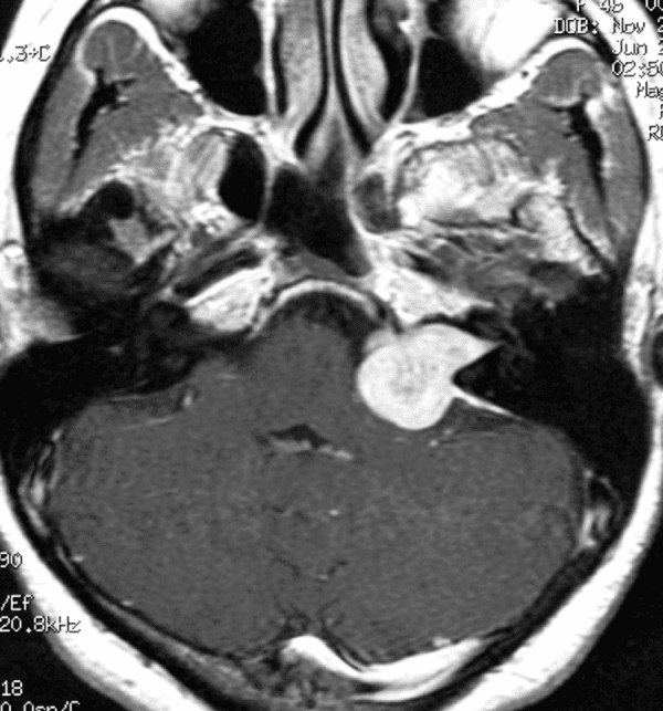**Imaging Modality:** Axial T1-weighted Magnetic Resonance Imaging (MRI) with gadolinium contrast.
**Anatomical Region:** Posterior cranial fossa, specifically the left cerebellopontine angle (CPA) and internal auditory canal (IAC).
**Observed Pathology:** A well-circumscribed, intensely enhancing extra-axial mass is located in the left cerebellopontine angle. The lesion demonstrates the classic "ice cream cone" configuration, characterized by a bulbous component within the CPA cistern and a narrow extension into the widened left internal auditory canal.
**Characteristic Visual Features:**
* **Enhancement:** Homogeneous and robust post-contrast enhancement.
* **Morphology:** Expansile growth causing focal widening of the porus acusticus.
* **Mass Effect:** Minimal displacement of the adjacent brainstem and cerebellum without significant perilesional edema or ventricular effacement.
* **Symmetry:** The contralateral (right) internal auditory canal and CPA cistern appear normal.
**Diagnostic Entity:** The findings are highly characteristic of a vestibular schwannoma (acoustic neuroma).
**Clinical Significance:** This image illustrates a typical presentation of a Grade II or III vestibular schwannoma (Koos classification) based on its extension into the cistern and widening of the bony canal.