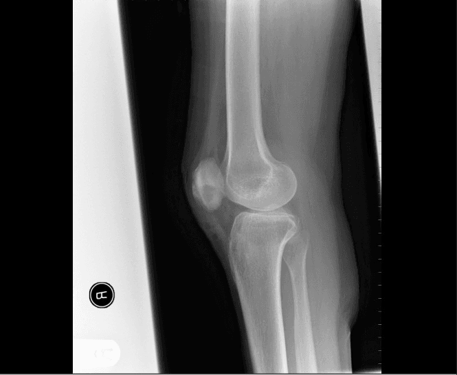 **Imaging Modality:** Conventional Radiography (X-ray)
**Anatomical Region:** Right knee, lateral view
**Description:**
The image shows a lateral radiograph of the knee demonstrating a well-circumscribed, focal lytic lesion located within the inferior pole of the patella. The lesion is characterized by a radiolucent center with a subtle sclerotic margin. There is evidence of a minor periosteal reaction along the anterior cortex of the patella, accompanied by localized soft tissue swelling in the prepatellar and infrapatellar regions. The tibiofemoral joint space appears preserved, and no gross fractures or significant joint effusions are visualized.
**Pathology/Clinical Context:**
The radiographic appearance is consistent with a Brodie’s abscess, a form of subacute pyogenic osteomyelitis. Key diagnostic features include the localized lucency within the sesamoid bone and the associated inflammatory changes in the overlying soft tissue.
**Key Features for Retrieval:**
* **Modality:** X-ray
* **Anatomy:** Patella, knee joint
* **Pathology:** Brodie’s abscess, subacute osteomyelitis, lytic bone lesion
* **Radiologic Signs:** Focal lucency, periosteal reaction, soft tissue edema