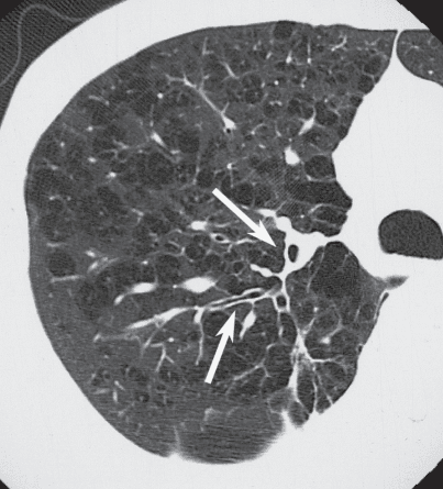**Imaging Modality:** High-resolution computed tomography (HRCT), axial section.
**Anatomical Region:** Right lung parenchyma.
**Observed Pathology:** Advanced pulmonary emphysema with comorbid small airway disease.
**Characteristic Visual Features:**
* **Emphysema:** The lung field exhibits diffuse, multi-focal areas of low attenuation (lucency) representing alveolar destruction. Findings are consistent with centrilobular and paraseptal emphysema, appearing as multiple small, thin-walled cystic spaces and bullae.
* **Bronchial Wall Thickening:** There is conspicuous thickening of the bronchial walls (indicated by white arrows). The increased wall-to-lumen ratio suggests chronic inflammatory changes or remodeling.
* **Luminal Narrowing:** Associated with the wall thickening, several bronchioles demonstrate a narrowed caliber (stenosis), contributing to a "signet ring" appearance in some cross-sections but with a reduced internal diameter.
* **Vascular Attenuation:** Peripheral pulmonary vasculature appears attenuated and displaced by the hyperinflated, emphysematous lung parenchyma.
**Diagnostic Significance:** This combination of parenchymal hyperlucency and bronchial wall thickening is characteristic of chronic obstructive pulmonary disease (COPD) with a significant chronic bronchitis component. The image illustrates the coexistence of large-space destruction and airway remodeling.