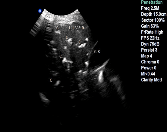**Imaging Modality:** Abdominal Ultrasound (B-mode)
**Anatomical Region:** Upper abdomen, specifically the liver parenchyma and adjacent gallbladder (labeled "GB").
**Observed Pathology:** Multiple intrahepatic calcifications.
**Characteristic Visual Features:**
The ultrasound image displays numerous, discrete, highly echogenic (bright) foci distributed throughout the hepatic parenchyma. These lesions exhibit classic posterior acoustic shadowing, characterized by dark vertical bands extending deep to the echogenic structures due to the attenuation of the sound beam. The distribution is multifocal and irregular, resulting in a distorted parenchymal echo pattern. The adjacent gallbladder is visible but partially obscured by the shadowing artifacts from overlying calcified structures.
**Key Diagnostic Features:**
- **Hyper-echogenicity:** Distinct white foci indicating mineralized or dense tissue.
- **Posterior Acoustic Shadowing:** Confirms the solid, calcified nature of the lesions.
- **Anatomical Distortion:** Visible alteration of the normal homogeneous liver texture by multiple shadowing calcifications.
**Clinical Significance:** This pattern is characteristic of disseminated intrahepatic calcifications, which may be secondary to chronic granulomatous disease, healed infections (e.g., tuberculosis or histoplasmosis), or biliary calculi.
