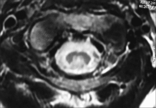 **Imaging Modality:** Magnetic Resonance Imaging (MRI), Axial T2-weighted sequence.
**Anatomical Region:** Cervical spinal cord.
**Observed Pathology:** Symmetrical intramedullary T2 hyperintensities localized within the posterior columns (dorsal columns) of the spinal cord.
**Characteristic Visual Features:** The image demonstrates a distinct "inverted V" or "rabbit ear" pattern of high signal intensity involving the fasciculus gracilis and fasciculus cuneatus. The gray matter H-shape is relatively spared, and the peripheral white matter remains largely isointense. There is no evidence of significant cord expansion or compressive myelopathy at this level.
**Clinical Context & Differential:** This radiological sign is highly characteristic of Subacute Combined Degeneration (SCD) of the spinal cord, typically associated with Vitamin B12 deficiency. Other diagnostic considerations for posterior column T2 hyperintensities include copper deficiency myelopathy, Friedreich's ataxia, or infectious etiologies such as tabes dorsalis.
**Indexing Keywords:** Axial T2 MRI, Cervical Spinal Cord, Posterior Column Hyperintensity, Inverted V Sign, Subacute Combined Degeneration, Demyelination, Intramedullary Signal Abnormality.