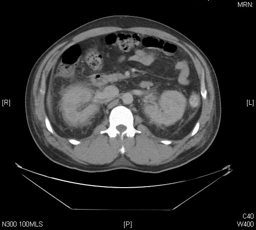 **Imaging Modality:** Axial computed tomography (CT) of the abdomen without oral contrast.
**Anatomical Region:** Mid-abdominal section at the level of the kidneys and lumbar spine.
**Observed Pathology:** Bilateral renal enlargement with significant perinephric findings. Both kidneys exhibit a striated or heterogeneous enhancement pattern (nephrogram). There is prominent, symmetric thickening of the Gerota’s fascia and extensive perinephric fat stranding.
**Characteristic Visual Features:**
* **Perinephric Space:** Marked fluid-density infiltration and soft tissue stranding surrounding both kidneys, suggesting an acute inflammatory or infiltrative process.
* **Renal Parenchyma:** Bilateral swelling with poorly defined corticomedullary differentiation.
* **Associated Findings:** Mild thickening of the lateral conal fascia is noted. No gross hydronephrosis or obstructing calculi are immediately apparent in this single slice. Bowel loops appear unremarkable with normal gas distribution.
**Key Diagnostic Cues:** The constellation of bilateral renal swelling, striated nephrogram, and extensive perinephric stranding is highly suggestive of acute bilateral pyelonephritis or an acute systemic inflammatory/vascular condition affecting the renal interstitium. The symmetry of the findings is a critical distinguishing feature for differential diagnosis in renal imaging.