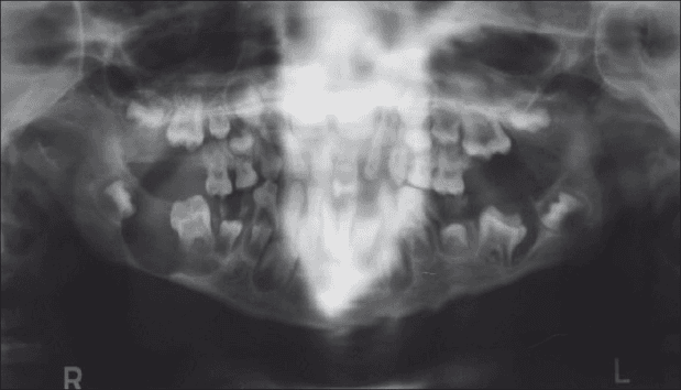 **Imaging Modality:** Panoramic radiograph (Orthopantomogram/OPG).
**Anatomical Region:** Maxillofacial region including the mandible, maxilla, and temporomandibular joints.
**Observed Pathology:** Large, well-defined multilocular radiolucent cystic lesions are visible bilaterally in the posterior mandible, extending from the molar regions into the ascending rami. These lesions demonstrate significant cortical thinning and medullary bone destruction.
**Key Visual Features:**
* **Mandibular Condyles:** Bilateral hypoplastic condyles characterized by reduced size and altered morphology.
* **Dentition:** Mixed dentition is present with evidence of multiple impacted, displaced, and malpositioned permanent teeth secondary to the expansive cystic lesions.
* **Bony Changes:** Extensive radiolucency indicates osteolytic activity, displacing the mandibular canal and compromising the structural integrity of the mandibular body and rami.
**Differentiating Features:** The combination of bilateral multilocular radiolucencies in a pediatric/adolescent patient, associated with tooth displacement and condylar hypoplasia, is highly suggestive of systemic or genetic bone pathologies such as cherubism or Gorlin-Goltz syndrome. The symmetry and posterior mandibular involvement are hallmark diagnostic cues.