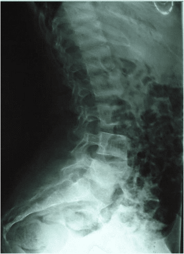 **Modality:** Lateral projection conventional radiograph (X-ray).
**Anatomical Region:** Lumbar spine and sacrum.
**Observed Pathology:** The image demonstrates classic "rugger jersey spine" appearance, a hallmark radiologic sign of renal osteodystrophy (secondary hyperparathyroidism).
**Characteristic Visual Features:**
- **Sclerotic Bands:** Prominent horizontal bands of increased radiodensity are visible at the superior and inferior endplates of multiple vertebral bodies.
- **Central Lucency:** The mid-portion of the vertebral bodies demonstrates relative osteopenia or decreased radiodensity compared to the dense endplates.
- **Pattern:** This alternating radiopaque-radiolucent-radiopaque pattern creates a striped appearance across the longitudinal axis of the spine.
- **Bone Quality:** Generalized alteration in trabecular pattern and mineralization is noted throughout the visualized lumbar vertebrae.
**Clinical Context/Differentiating Features:** This pattern is highly specific for chronic kidney disease (CKD) induced metabolic bone disease. The distribution of sclerosis at the endplates distinguishes it from other causes of osteosclerosis, such as osteopetrosis (which typically presents with more diffuse "bone-within-bone" appearance) or Paget's disease (which involves cortical thickening and coarser trabeculae).