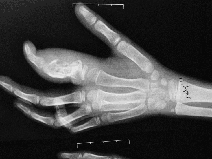 **Imaging Modality:** Plainfilm Radiograph (X-ray).
**Anatomical Region:** Oblique view of a pediatric hand and wrist.
**Observed Pathology:** Significant lytic destruction and expansile remodeling of the proximal phalanx of the second digit (index finger). The lesion is located distal to the proximal physis. There is associated fusiform soft tissue swelling surrounding the affected phalanx.
**Characteristic Visual Features:**
* **Osseous Findings:** The affected proximal phalanx demonstrates extensive cortical thinning, trabecular distortion, and a lucent, expansile appearance (dactylitis pattern). The distal aspect of the phalanx appears fragmented or severely eroded.
* **Pediatric Context:** Presence of open physes at the base of the metacarpals and phalanges indicates a skeletally immature patient.
* **Distribution:** Isolated involvement of the second proximal phalanx, with the remaining visualized metacarpals and phalanges appearing relatively spared of acute destructive changes.
**Key Diagnostic Features:** The combination of localized diaphyseal/metaphyseal bone destruction and significant soft tissue expansion in a pediatric patient is characteristic of tuberculous dactylitis (spina ventosa) or chronic fungal/pyogenic osteomyelitis. The preservation of the proximal physis helps localize the primary site of destruction to the metadiaphysis.