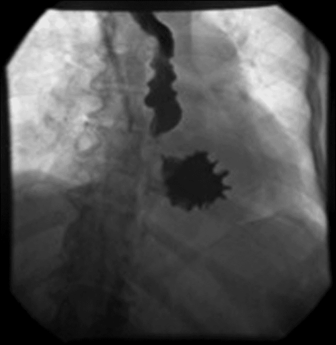 **Imaging Modality:** Fluoroscopic contrast study (Upper Gastrointestinal Series).
**Anatomical Region:** Upper abdomen and lower thorax, focusing on the esophagus and stomach.
**Observed Pathology:** Organoaxial gastric volvulus associated with a large hiatal hernia.
**Characteristic Visual Features:**
The image demonstrates a significant portion of the stomach herniated into the thoracic cavity. There is a characteristic rotation of the stomach along its longitudinal axis (the cardiopyloric line). The greater curvature is positioned superiorly to the lesser curvature, creating an "upside-down stomach" appearance. Contrast flow shows tapering and torsion at the point of rotation, with an abnormal horizontal orientation of the gastric body. The esophagus appears slightly dilated proximal to the herniation.
**Diagnostic Differentiating Features:**
The hallmark of organoaxial volvulus is the rotation around the long axis, distinguishing it from mesenteroaxial volvulus, which involves rotation around the short axis (mesentery). The presence of the stomach within the mediastinum confirms a paraesophageal or large sliding hiatal hernia as the predisposing anatomical defect. Such findings are critical for diagnosing acute or chronic gastric torsion and subsequent gastric outlet obstruction.