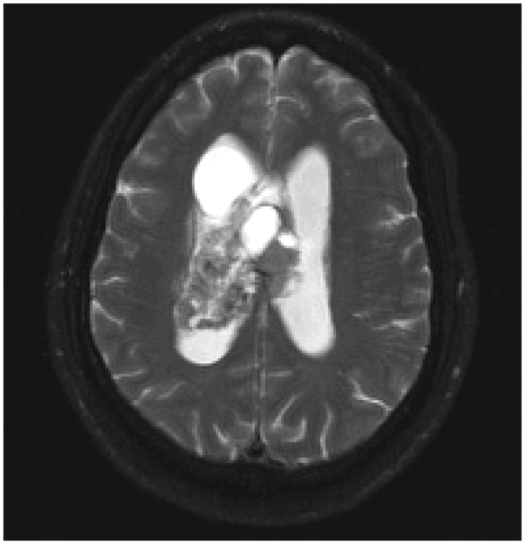 **Imaging Modality:** Axial T2-weighted Magnetic Resonance Imaging (MRI).
**Anatomical Region:** Intracranial, specifically the ventricular system at the level of the lateral ventricles and the septum pellucidum.
**Observed Pathology:** A large, well-circumscribed, heterogeneous intraventricular mass consistent with a central neurocytoma. The lesion is primarily located within the body of the right lateral ventricle, attached to the septum pellucidum, and extends across the midline.
**Characteristic Visual Features:** The mass exhibits a "bubbly" appearance, characterized by heterogeneous T2 hyperintensity with multiple internal cystic components or flow voids. The lesion causes significant mass effect, resulting in obstructive hydrocephalus as evidenced by the bilateral dilatation of the frontal and occipital horns of the lateral ventricles.
**Key Diagnostic Features:** The intraventricular location, broad-based attachment to the septum pellucidum, and the heterogeneous multicystic internal architecture are classic radiologic indicators of central neurocytoma, distinguishing it from other intraventricular neoplasms such as subependymoma or intraventricular meningioma.