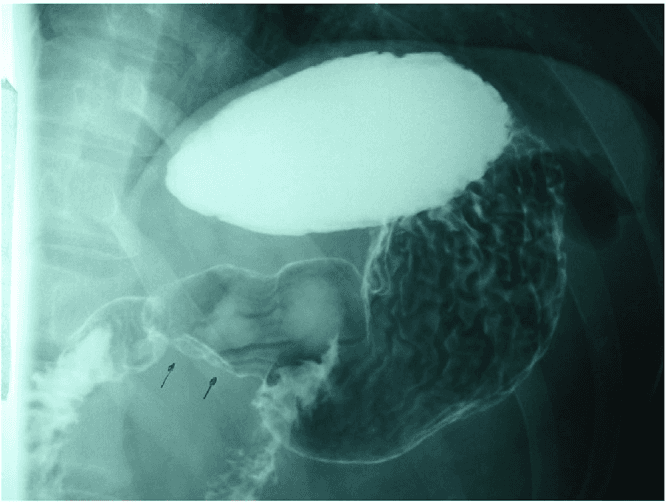 **Imaging Modality:** Fluoroscopic X-ray; Upper Gastrointestinal (UGI) Series with oral barium contrast (Barium Meal).
**Anatomical Region:** Upper abdomen, specifically the distal stomach, pylorus, and proximal duodenum.
**Observed Pathology:** The image demonstrates significant narrowing of the pyloric canal, appearing as a thin, elongated track of barium contrast (indicated by black arrows). This finding is classically referred to as the "string sign."
**Characteristic Visual Features:**
- **Stomach:** The gastric body and antrum appear dilated and filled with radiopaque barium contrast.
- **Pylorus:** There is a marked luminal narrowing at the gastroduodenal junction.
- **Duodenum:** Limited contrast is visible distal to the narrowing, suggesting partial gastric outlet obstruction.
- **Mucosal Pattern:** Prominent rugal folds are visible in the gastric body.
**Clinical Context & Differential:** The radiographic findings are highly characteristic of Hypertrophic Pyloric Stenosis (HPS), typically seen in pediatric populations, or secondary pyloric cicatrization/stenosis due to chronic peptic ulcer disease or malignancy in adults. The "string sign" serves as a key diagnostic cue for identifying significant pyloric luminal constriction.