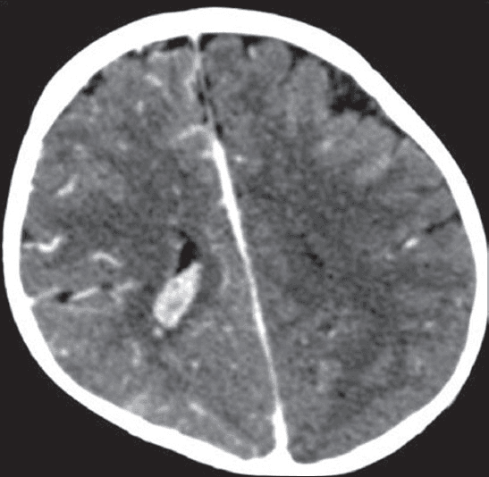 **Imaging Modality:** Axial contrast-enhanced Computed Tomography (CT) of the brain.
**Anatomical Region:** Supratentorial brain, specifically involving the right parietal lobe and the ventricular system.
**Observed Pathology:**
* **Vascular/Pia Mater:** Significant gyriform enhancement is visible along the cortical surface of the right high parietal lobe, suggesting pial angiomatosis.
* **Choroid Plexus:** Prominent enlargement and hyperdensity of the right glomus of the choroid plexus within the atrium of the lateral ventricle, consistent with ipsilateral choroid plexus hypertrophy.
* **Parenchymal Changes:** Localized cortical atrophy is noted in the contralateral (left) frontal region.
* **Calcification/Density:** Linear hyperdense tracks are present in the right parietal subcortical white matter, characteristic of intracranial calcification or anomalous venous drainage.
**Characteristic Visual Features:** The combination of leptomeningeal enhancement (pial angiomatosis) and an enlarged ipsilateral choroid plexus are hallmark radiologic features of Sturge-Weber syndrome (encephalotrigeminal angiomatosis).
**Key Diagnostic Features:** Ipsilateral cortical gyriform enhancement, choroid plexus enlargement, and focal cerebral atrophy.