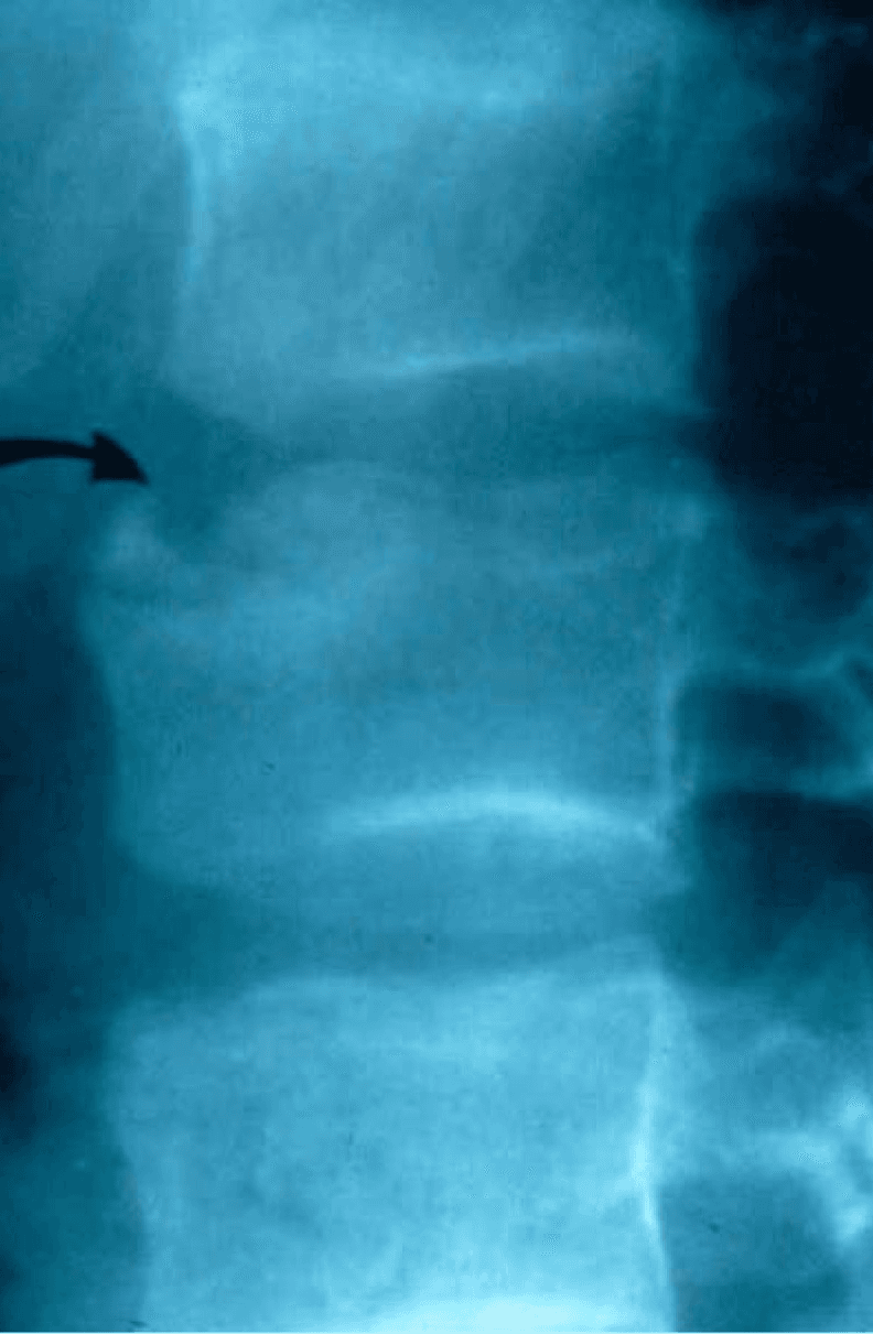 **Imaging Modality:** Lateral plain film radiograph (X-ray).
**Anatomical Region:** Thoracolumbar spine, focusing on multiple contiguous vertebral bodies.
**Observed Pathology:** The image demonstrates classic radiologic features of Scheuermann’s kyphosis. Key findings include:
* **Vertebral Wedging:** Anterior shortening of the vertebral bodies, contributing to an increased thoracic kyphotic curvature.
* **End-plate Irregularities:** Undulating and fragmented superior and inferior vertebral end-plates, indicated by the black arrow.
* **Schmorl’s Nodes:** Intravertebral disc herniations visible as focal radiolucent indentations into the vertebral end-plates.
* **Disc Space Narrowing:** Reduced intervertebral disc height in the affected segments.
**Characteristic Visual Features:** The vertebrae exhibit a loss of the normal rectangular profile in favor of a wedged morphology. There is evidence of subchondral sclerosis adjacent to the irregular end-plates.
**Clinical Context:** These structural changes are diagnostic of juvenile osteochondrosis of the spine (Scheuermann's disease), characterized by fixed hyperkyphosis and secondary degenerative changes of the spinal column.
