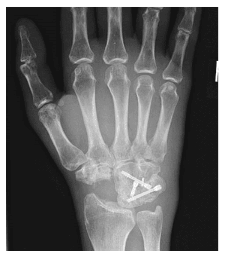 **Imaging Modality:** Conventional Radiography (X-ray)
**Anatomical Region:** Right hand and wrist
**View:** Anteroposterior (AP) projection
**Observed Pathology/Findings:**
The image demonstrates a status post-surgical intervention for carpal collapse, specifically a four-corner arthrodesis. The scaphoid bone is absent, consistent with a total scaphoidectomy. Internal fixation is visible within the midcarpal joint, consisting of three headless compression screws (e.g., Herbert screws) securing the capitate, hamate, triquetrum, and lunate.
**Characteristic Visual Features:**
* **Fusion:** There is radiologic evidence of consolidated osseous bridging across the capitate-lunate, capitate-hamate, hamate-triquetrum, and lunate-triquetrum interfaces, indicating a successful fusion mass.
* **Alignment:** The radiolunate joint space is preserved.
* **Hardware:** The metallic screws are intact with no evidence of loosening, migration, or periprosthetic lucency.
* **Secondary Findings:** Mild degenerative changes are noted at the first carpometacarpal (CMC) joint and distal radioulnar joint.
**Key Diagnostic Features:**
Post-scaphoidectomy four-corner fusion with stable internal hardware and mature bony union, typically performed for SLAC (Scapholunate Advanced Collapse) or SNAC (Scaphoid Nonunion Advanced Collapse) wrist patterns.