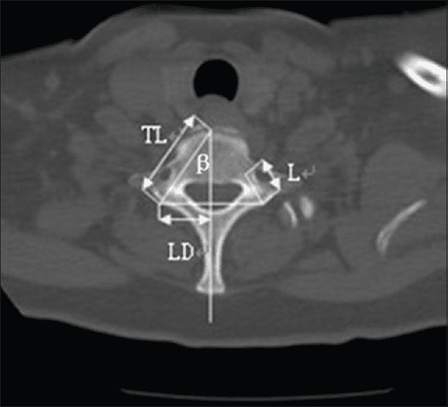 **Modality:** Computed Tomography (CT), Axial plane.
**Anatomy:** Cervical spine, specifically the C7 vertebra. Key landmarks include the vertebral body, spinal canal, pedicles, transverse processes, and spinous process.
**Description:** This image demonstrates a quantitative morphometric analysis of the C7 vertebra. Linear and angular measurements are overlaid on the osseous structures to evaluate pedicle morphology.
- **TL (Total Length):** Chord length measurement from the posterior entry point of the pedicle to the anterior cortex of the vertebral body.
- **L (Pedicle Width):** Transverse diameter of the pedicle.
- **LD (Lamina Distance):** Horizontal distance from the midline to the lateral aspect of the vertebral arch.
- **β (Pedicle Angle):** The transverse angulation of the pedicle axis relative to the mid-sagittal plane.
**Clinical Context:** These measurements are typically utilized for preoperative planning in spinal surgery, specifically for the safe placement of transpedicular screws. The image highlights the anatomical constraints and the trajectory required to avoid neurovascular injury to the spinal cord or vertebral arteries. No acute fracture or gross pathology is visualized in the displayed bone window.