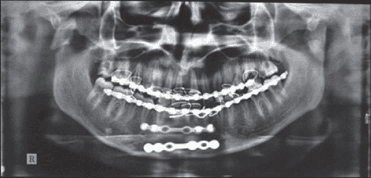 **Imaging Modality:** Orthopantomogram (OPG/Panoramic Radiograph).
**Anatomical Region:** Mandible, maxilla, and temporomandibular joints (TMJs).
**Observed Pathology and Hardware:**
* **Mandibular Parasymphysis:** Evidence of a surgically treated fracture at the mandibular parasymphysis. Internal fixation is visible, consisting of two horizontal, multi-hole radiopaque mini-plates secured with monocortical/bicortical screws along the inferior border and mid-body of the anterior mandible.
* **Mandibular Condyles:** Bilateral fractures of the mandibular condylar processes are visible. The condylar heads show displacement and lack of surgical hardware, indicating conservative management or an untreated state.
* **Maxillomandibular Fixation (MMF):** Continuous radiopaque arch bars are present on both the maxillary and mandibular dentition, secured with interdental wiring to facilitate stabilization and occlusal alignment.
**Characteristic Visual Features:**
* Radiopaque osteosynthesis hardware (plates and screws) in the anterior mandible.
* Discontinuity and angulation of the condylar necks bilaterally.
* Metallic artifacts from orthodontic/surgical arch bars and wires across the dental arches.
**Clinical Context:** Post-operative imaging following Open Reduction and Internal Fixation (ORIF) of a parasymphyseal fracture, with concomitant bilateral condylar fractures managed via closed reduction/immobilization.