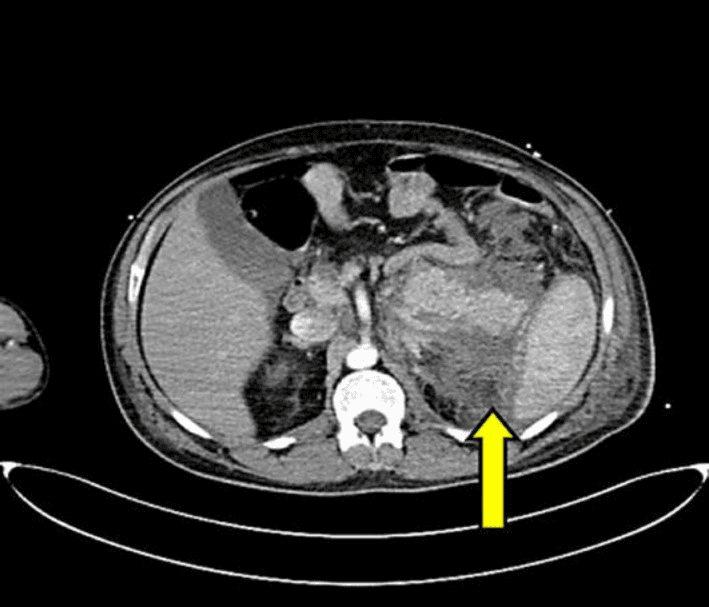 **Imaging Modality:** Contrast-enhanced computed tomography (CECT) of the abdomen.
**Anatomical Region:** Axial section at the level of the upper abdomen, showing the pancreas, liver, spleen, and kidneys.
**Observed Pathology:** The image demonstrates findings consistent with acute pancreatitis. There is significant inflammatory changes and edema involving the pancreatic parenchyma. A prominent, low-attenuation peripancreatic fluid collection is visible (indicated by the yellow arrow).
**Characteristic Visual Features:**
* **Pancreas:** Diffuse enlargement with ill-defined borders and heterogeneous enhancement.
* **Fluid Collection:** An acute peripancreatic fluid collection (APFC) is noted in the anterior pararenal space, extending laterally into the splenorenal space.
* **Fat Stranding:** Increased density and "dirty" appearance of the peripancreatic fat, indicating active inflammation.
* **Adjacent Structures:** The collection is bordered by the tail of the pancreas and the medial aspect of the spleen.
**Key Diagnostic Features:** The combination of pancreatic swelling, heterogeneous contrast enhancement, and organized peripancreatic fluid in the splenorenal space are characteristic radiologic markers for grading the severity of acute pancreatitis using the Balthazar or CT Severity Index (CTSI) criteria.