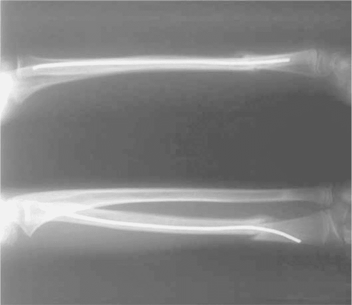 **Modality:** Conventional radiography (X-ray) in two views.
**Anatomical Region:** Forearm, specifically the radius and ulna including the distal radioulnar joint (DRUJ) and wrist.
**Observed Pathology:** Post-surgical reduction of a Galeazzi fracture-dislocation. There is a mid-to-distal third radial shaft fracture demonstrating interval reduction and stabilization.
**Characteristic Features:**
- **Internal Fixation:** A radio-opaque flexible intramedullary (IM) nail is visible within the medullary canal of the radius.
- **Entry Point:** The IM nail is inserted via the distal radial metaphysis, traversing the fracture site to provide axial alignment.
- **Alignment:** The radial shaft shows improved anatomical alignment with visible cortical apposition at the fracture site.
- **Associated Findings:** The distal radioulnar joint is visualized to assess for stabilization following the reduction of the radial length.
**Diagnostic Context:** This image demonstrates the use of intramedullary nailing as a surgical intervention for pediatric or adolescent Galeazzi-type injuries, focusing on restoring radial length and secondary stability of the distal radioulnar joint.