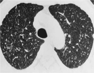 **Imaging Modality:** High-resolution computed tomography (HRCT) of the chest in axial plane, lung window.
**Anatomical Region:** Upper lobes of the lungs at the level of the trachea.
**Observed Pathology:** Coal workers' pneumoconiosis (CWP) presenting as simple pneumoconiosis.
**Characteristic Visual Features:**
* **Nodular Pattern:** Diffuse, bilateral distribution of small, ill-defined centrilobular nodules.
* **Distribution:** Marked predominance in the upper lobes and posterior segments of the lungs.
* **Nodule Morphology:** The nodules vary slightly in size and lack the "tree-in-bud" configuration, indicating an interstitial rather than an endobronchial inflammatory process.
* **Lung Parenchyma:** Background lung attenuation appears largely preserved without significant evidence of conglomerate masses or progressive massive fibrosis (PMF) in this specific section.
**Differentiating Features:** The absence of branching linear opacities (tree-in-bud) helps distinguish this occupational dust inhalation pattern from infectious bronchiolitis. The posterior and upper lobe distribution is characteristic of mineral dust exposure, such as coal dust or silica.