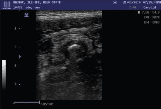 **Imaging Modality:** B-mode Ultrasound (Sonography)
**Anatomical Region:** Right lower quadrant of the abdomen
**Observed Pathology:** Acute appendicitis with appendicolith.
**Characteristic Visual Features:**
* **Transverse View:** The image displays a cross-section of the vermiform appendix appearing as a non-compressible, blind-ending tubular structure.
* **Target Sign:** A classic "target" or "bull’s-eye" appearance is visible, characterized by concentric layers of varying echogenicity representing the inflamed appendiceal wall layers (mucosa, submucosa, and muscularis propria).
* **Appendicolith:** A distinct, highly echogenic (hyperechoic) foci is located within the lumen of the appendix, associated with subtle posterior acoustic shadowing, indicative of a fecalith or appendicolith.
* **Wall Changes:** There is evidence of mural thickening and luminal distension.
* **Surrounding Tissue:** Increased echogenicity of the periappendiceal fat is noted, suggestive of secondary inflammatory changes (fat stranding).
**Key Diagnostic Features:** The combination of a dilated appendiceal diameter, the presence of an intraluminal obstructing appendicolith, and the distinct target sign in the transverse plane are definitive sonographic markers for acute obstructive appendicitis.