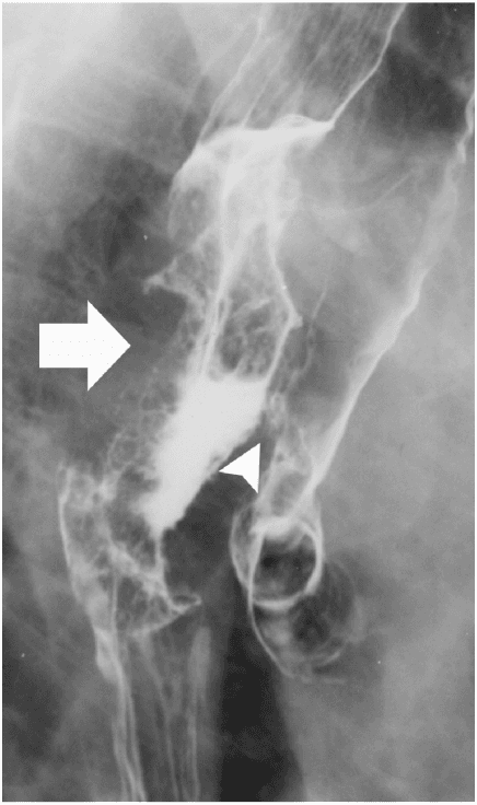 **Imaging Modality:** Fluoroscopic esophagram (barium swallow), spot film.
**Anatomical Region:** Mid-to-distal esophagus and adjacent tracheobronchial tree.
**Observed Pathology:** The image demonstrates a high-grade malignant esophageal stricture secondary to squamous cell carcinoma. There is an irregular, circumferential mucosal pattern with associated luminal narrowing and "apple-core" apple-core-like shouldering (indicated by the large arrow).
**Characteristic Visual Features:**
- **Esophageal Findings:** Severe luminal narrowing with irregular, nodular mucosal surfaces and abrupt transition zones.
- **Tracheoesophageal Fistula (TEF):** A definitive fistulous tract is visible (indicated by the arrowhead), where contrast medium extravasates anteriorly from the esophageal lumen into the trachea and primary bronchi.
- **Contrast Distribution:** Radiopaque contrast outlines the bronchial tree, confirming aspiration or fistulous communication between the digestive and respiratory tracts.
**Diagnostic Differentiating Features:** The presence of irregular mucosal destruction and luminal eccentricity is highly suggestive of primary esophageal malignancy. The visualization of barium within the tracheobronchial tree following esophageal opacification is the pathognomonic finding for an acquired tracheoesophageal fistula, a known complication of advanced esophageal carcinoma.