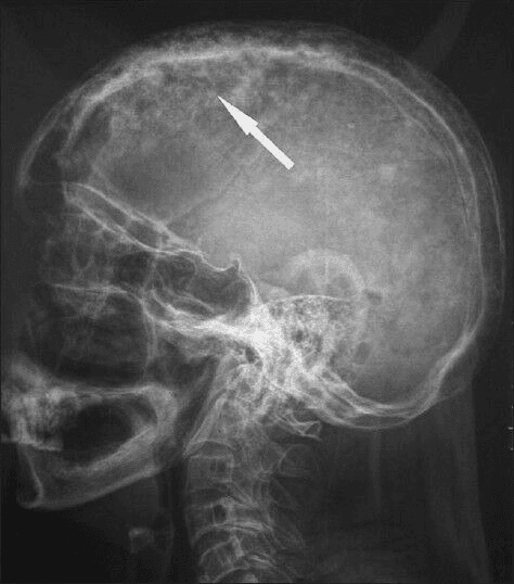 **Imaging Modality:** Lateral plain film radiograph (X-ray).
**Anatomical Region:** Lateral view of the skull (calvaria) and upper cervical spine.
**Observed Pathology:** The image demonstrates classic radiologic features of Paget's disease of bone (osteitis deformans) affecting the skull.
**Characteristic Visual Features:**
* **Cotton-Wool Appearance:** The calvaria exhibits generalized, patchy, mixed radiolucent and radiopaque areas, creating a characteristic "cotton-wool" appearance.
* **Cortical Thickening:** Significant thickening of the inner and outer tables of the skull is evident, particularly in the frontal and parietal regions.
* **Diploic Space Expansion:** There is a marked widening of the diploic space with loss of the normal distinct margins between the tables.
* **Distribution:** Findings are diffuse throughout the vault of the skull.
**Key Diagnostic Features:** The combination of calvarial thickening and the multifocal sclerotic patches (cotton-wool spots) is highly suggestive of the sclerotic (late) phase of Paget’s disease, distinguishing it from metastatic disease or primary bone malignancies. White arrow indicates a prominent area of mixed bone density within the parietal bone.
