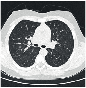 **Imaging Modality:** High-resolution computed tomography (HRCT) of the chest.
**Anatomical Region:** Axial section of the thorax at the level of the main bronchi and pulmonary hila.
**Observed Pathology:** Hypersensitivity pneumonitis (extrinsic allergic alveolitis).
**Characteristic Visual Features:**
The image demonstrates diffuse, bilateral ground-glass opacities (GGO) involving both lung fields. There is a prominent pattern of poorly defined centrilobular nodules, which are characteristic of the subacute phase of hypersensitivity pneumonitis. The distribution appears relatively uniform without significant craniocaudal or peripheral sparing in this single slice. No evidence of honeycombing, traction bronchiectasis, or significant architectural distortion is visible, suggesting an absence of advanced fibrosis. The bronchial structures and mediastinal contours appear within normal limits for this section.
**Key Diagnostic Features:**
The combination of widespread ground-glass attenuation and subtle centrilobular nodularity is highly suggestive of an inflammatory interstitial lung disease, specifically hypersensitivity pneumonitis triggered by inhaled organic antigens. These findings assist in differentiating the condition from other interstitial pneumonias or acute alveolar processes.