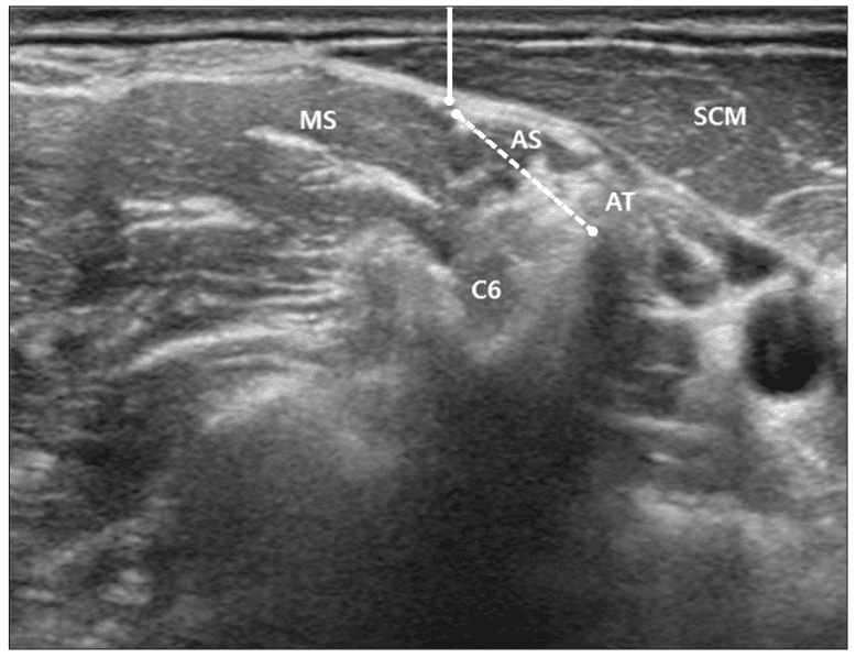 **Imaging Modality:** Ultrasound (B-mode)
**Anatomical Region:** Lateral cervical region (neck) at the level of the sixth cervical vertebra (C6).
**Key Landmarks and Structures:**
* **Musculature:** The sternocleidomastoid muscle (SCM) is visible superficially. The anterior scalene muscle (AS) and middle scalene muscle (MS) are identified in the interscalene groove.
* **Neural Structures:** The phrenic nerve is visualized on the superficial surface of the anterior scalene muscle. The C6 nerve root is visible deep to the scalene musculature.
* **Bony Landmarks:** The anterior tubercle (AT) of the C6 transverse process is identified as a hyperechoic structure with posterior acoustic shadowing.
**Observed Measurements/Features:**
* **Phrenic Nerve Depth:** Indicated by a solid vertical line measuring the shortest distance from the skin surface to the phrenic nerve epineurium.
* **Anatomical Relationship:** A dotted line illustrates the spatial relationship and distance between the phrenic nerve and the C6 anterior tubercle.
**Clinical Context:** This sonogram demonstrates the regional anatomy relevant for ultrasound-guided nerve blocks or phrenic nerve identification, highlighting the nerve’s proximity to the skin surface and cervical landmarks.