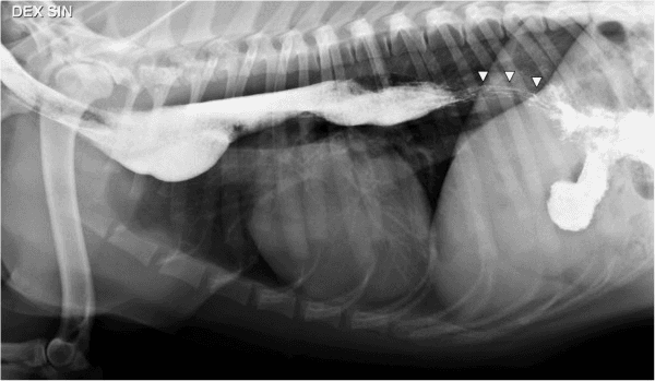 **Imaging Modality:** Lateral thoracic radiograph; positive-contrast esophagram (barium study).
**Anatomical Region:** Thorax, specifically the esophagus and cranial abdomen.
**Observed Pathology:**
* **Megaesophagus:** Generalized, moderate-to-severe esophageal dilation extending from the cervical region to the diaphragm.
* **Esophageal Diverticulum:** Focal ventral saccular distension of the esophagus located in the cranial mediastinum, just cranial to the cardiac silhouette.
* **Herringbone Pattern:** Characteristic "striped" or "herringbone" mucosal pattern visible in the distal (caudal) thoracic esophagus (indicated by arrowheads), representing normal feline esophageal anatomy where the distal third is composed of smooth muscle with circumferential mucosal folds.
**Characteristic Visual Features:**
* Radio-opaque barium contrast outlines the dilated esophageal lumen.
* Significant contrast retention within the thoracic esophagus.
* Contrast passage into the stomach (gastrogram) is present.
* No evidence of aspiration pneumonia is visible in the visualized lung fields.
**Diagnostic Features:** The combination of generalized dilation with a focal ventral pouching (diverticulum) and a normal distal feline herringbone pattern. These findings are consistent with chronic esophageal dysmotility and secondary structural changes.