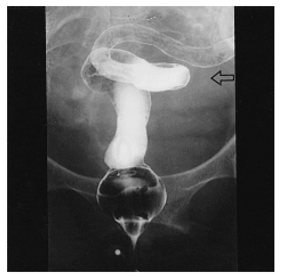 **Imaging Modality:** Fluoroscopic Barium Enema (single-contrast study).
**Anatomical Region:** Lower gastrointestinal tract, specifically the rectum and sigmoid colon.
**Observed Pathology:** Chronic inflammatory bowel disease, consistent with ulcerative colitis.
**Characteristic Visual Features:**
* **Lead Pipe Appearance:** There is a marked loss of normal haustral markings throughout the visualized segments of the distal colon, resulting in a smooth, featureless, and tubular appearance of the bowel wall.
* **Luminal Narrowing:** Diffuse and symmetric narrowing of the colonic lumen is evident in the rectum and sigmoid colon.
* **Shortening:** The affected segments appear shortened and rigid.
* **Landmarks:** A rectal catheter with an inflated retention balloon is visible at the inferior aspect of the image. An open arrow points to the featureless descending/sigmoid junction where haustral loss is prominent.
**Key Diagnostic Features:** The combination of diffuse haustral effacement and luminal narrowing ("lead pipe" sign) is a classic radiologic indicator of chronic ulcerative colitis, distinguishing it from the skip lesions and focal strictures typically seen in Crohn's disease.