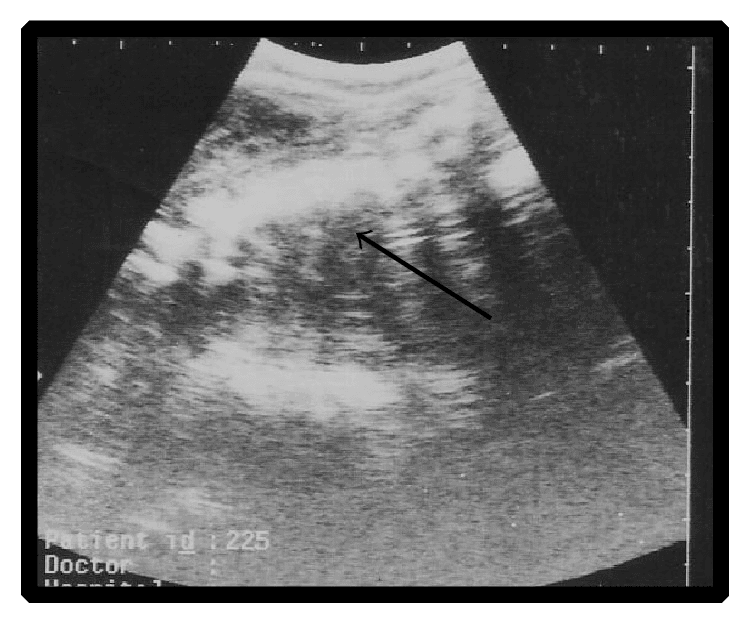 **Imaging Modality:** B-mode pelvic ultrasound (sonography).
**Anatomical Region:** Intrauterine environment during the second trimester of gestation.
**Observed Pathology:** Intrauterine fetal demise (IUFD) at approximately 120 days of gestation.
**Characteristic Visual Features:** The image displays a sagittal or oblique view of a single fetus. Key sonographic findings include the loss of normal fetal anatomical definition and a disorganized echogenic mass within the uterine cavity. There is a notable absence of distinct cardiac activity or fetal movement. An arrow indicates the non-viable fetal remains, which appear heterogeneously echogenic compared to the surrounding hypoechoic amniotic fluid.
**Key Diagnostic Features:** The presence of a collapsed fetal pole and fragmented structural echoes (consistent with maceration or early fetal resorption) are primary indicators of non-viability at this gestational stage. The image captures the diagnostic visualization of fetal death in a clinical obstetric setting.