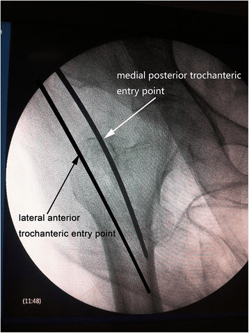 **Imaging Modality:** Intraoperative fluoroscopy (Anteroposterior radiograph).
**Anatomical Region:** Proximal femur, specifically the greater trochanter and femoral neck.
**Key Landmarks:** Greater trochanter apex, femoral shaft, and pelvic acetabulum (partially visible).
**Observed Procedure/Clinical Context:** Comparison of surgical entry points for intramedullary nail or guide pin insertion during orthopedic hip surgery. The image features two superimposed guide pins or markers indicating distinct trajectories.
**Characteristic Visual Features:**
* **Lateral Anterior (LA) Entry Point:** A guide pin positioned 0.5 cm lateral to the apex of the greater trochanter.
* **Medial Posterior (MP) Entry Point:** A guide pin positioned 0.5 mm medial to the apex on the medial edge of the greater trochanter.
* **Visual Annotation:** White arrows and black text labels directly identify the "lateral anterior trochanteric entry point" and the "medial posterior trochanteric entry point."
**Diagnostic/Differentiating Features:** The image demonstrates the spatial relationship between trochanteric anatomy and orthopedic instrumentation trajectories in the coronal plane. This visualization is critical for optimizing nail alignment and preventing iatrogenic fractures or malalignment during femoral fracture fixation.