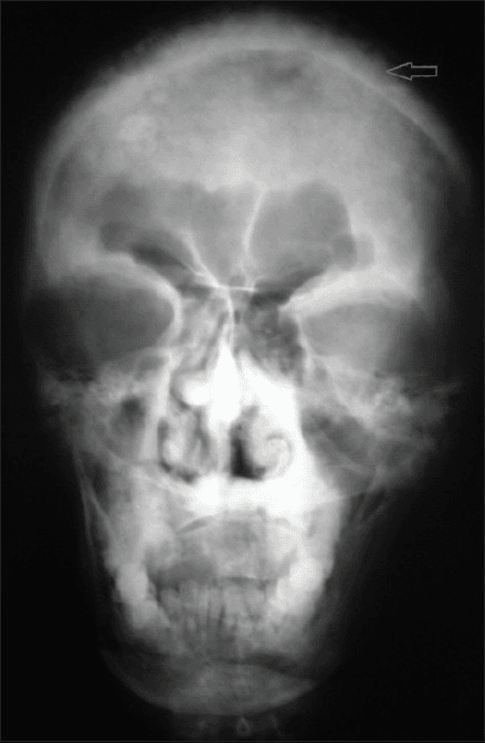 **Imaging Modality:** Conventional Radiography (X-ray)
**Anatomical Region:** Skull, Postero-anterior (PA) view
**Observed Pathology:**
The radiograph demonstrates diffuse, multi-focal osseous changes throughout the calvarium. There is a characteristic "cotton wool" appearance, defined by irregular, sclerotic radiopaque flecks and patches interspersed with areas of lucency.
**Characteristic Visual Features:**
- **Calvarial Thickening:** Marked expansion and thickening of the inner and outer tables of the skull.
- **Sclerotic Pattern:** Generalized distribution of patchy, ill-defined radiopacities involving the frontal, parietal, and facial bones.
- **Sinus Involvement:** Opacification of the bilateral maxillary antra, consistent with bone remodeling or secondary sinus obstruction.
- **Structural Integrity:** Loss of normal cortical-medullary differentiation within the cranial vault.
**Relevant Clinical Context:**
The radiographic presentation is highly characteristic of the sclerotic (late) phase of Paget’s disease of bone (osteitis deformans).
**Key Diagnostic Features:**
The combination of cortical thickening, skull expansion, and the "cotton wool" matrix of irregular radiopacities are pathognomonic findings for Pagetoid involvement of the craniofacial skeleton.