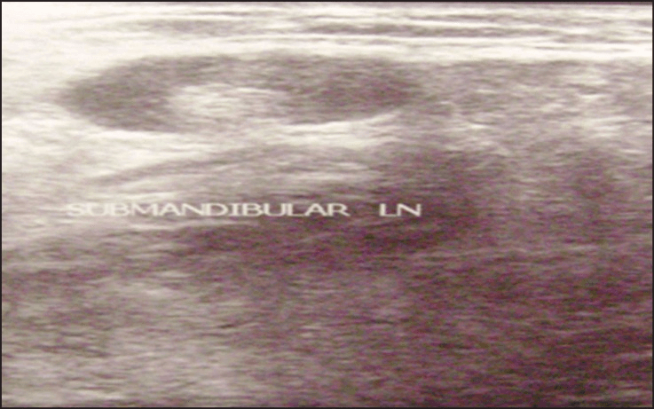 **Imaging Modality:** B-mode Ultrasound (Ultrasonography)
**Anatomical Region:** Submandibular space of the neck.
**Observed Pathology:** Cellulitis and reactive lymphadenopathy.
**Visual Features:**
- **Soft Tissue:** The image demonstrates increased echogenicity and thickening of the subcutaneous fat layers, characteristic of inflammatory "cobblestoning" or cellulitis. There is a loss of distinct fascial plane definition.
- **Lymph Node:** A prominent, oval-shaped hypoechoic structure is labeled as a "SUBMANDIBULAR LN" (lymph node). It exhibits a well-defined border and a visible hyperechoic central fatty hilum, suggesting a reactive rather than malignant process.
- **Echotexture:** The surrounding parenchyma shows a heterogenous, edematous appearance with diffuse low-level echoes, consistent with inflammatory fluid infiltration within the submandibular space.
**Diagnostic Features:**
The combination of diffuse soft tissue edema (cellulitis) and a reactive lymph node in the submandibular region is a key diagnostic indicator for localized orodontogenic or cervical infection. The absence of a clear, anechoic fluid collection suggests cellulitis rather than an organized abscess at this stage.
