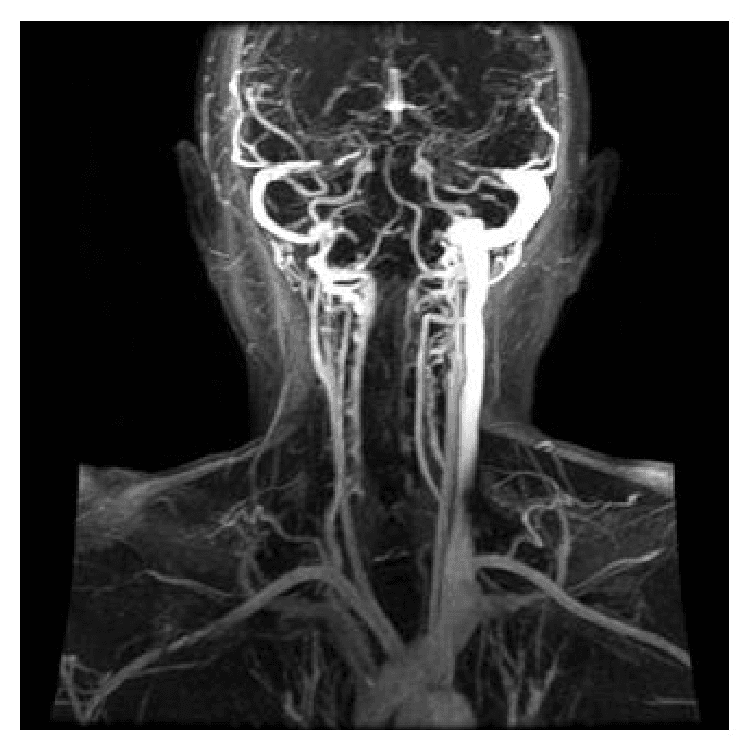 **Imaging Modality:** Coronal maximum intensity projection (MIP) reconstruction of a dynamic contrast-enhanced Magnetic Resonance Venogram (MRV).
**Anatomical Region:** Head and neck, focusing on the dural venous sinuses and the internal jugular veins (IJVs).
**Observed Pathology:** There is a significant asymmetry in the venous outflow. The right internal jugular vein demonstrates a near-complete lack of contrast opacification distal to the jugular bulb, indicating an occlusion or high-grade stenosis. In contrast, the left internal jugular vein is patent but appears markedly dilated (ectatic) and thickened, likely representing compensatory flow.
**Characteristic Visual Features:**
* **Filling Defect:** Absence of the normal high-signal column in the right IJV.
* **Vascular Morphometry:** Prominent enlargement of the contralateral (left) cervical venous system.
* **Collateralization:** Visible smaller venous collaterals in the cervical region.
**Differentiating Features:** The sudden termination of the contrast column on the right at the level of the jugular foramen suggests internal jugular vein thrombosis or extrinsic compression, while the compensatory dilatation of the left IJV is a secondary hemodynamic response.