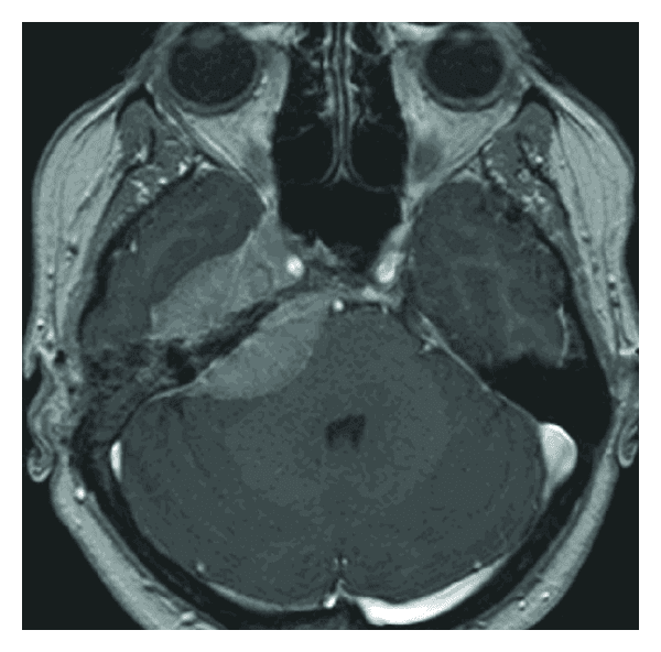 **Imaging Modality:** Axial T1-weighted magnetic resonance imaging (MRI) with gadolinium contrast enhancement.
**Anatomical Region:** Cranial base, specifically the right petrous apex and cerebellopontine angle (CPA).
**Observed Pathology:** A well-circumscribed, intensely enhancing extra-axial mass lesion consistent with a meningioma. The lesion is centered on the right petrous apex, extending into both the anterior and posterior compartments of the petrous temporal bone.
**Characteristic Visual Features:**
* **Enhancement Pattern:** Homogeneous and robust uptake of gadolinium contrast.
* **Morphology:** Dural-based, biconvex mass exerting a mass effect on the adjacent brainstem and cerebellum.
* **Dural Tail Sign:** Linear enhancement of the tapering dura mater extending from the edges of the lesion, a classic radiographic indicator of meningioma.
* **Topography:** Involvement of the right petrous apex with proximity to the internal auditory canal and Meckel’s cave.
**Key Diagnostic Features:** The extra-axial location, broad dural base, intense homogeneous enhancement, and presence of a dural tail are primary features distinguishing this lesion from other CPA masses such as vestibular schwannomas.