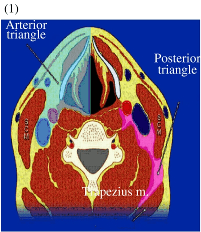 **Imaging Modality:** Anatomical cross-sectional diagram (schematic).
**Anatomical Region:** Axial view of the neck at the level of the cervical vertebrae.
**Key Landmarks:**
- **Musculature:** Sternocleidomastoid (SCM) muscle, trapezius muscle, and prevertebral muscles are clearly delineated.
- **Skeletal Structures:** Cervical vertebra with visible spinal canal.
- **Vascular/Soft Tissue:** Internal jugular vein and carotid artery are represented.
**Characteristic Visual Features:**
The diagram uses color-coded overlays to differentiate the primary fascial spaces and anatomical compartments of the neck.
- **Anterior Triangle:** Highlighted on the left side of the diagram, bounded by the midline, the anterior border of the SCM, and the mandible (superiorly).
- **Posterior Triangle:** Highlighted on the right side of the diagram, bounded by the posterior border of the SCM, the anterior border of the trapezius, and the clavicle (inferiorly).
**Clinical/Diagnostic Relevance:**
This schematic is used for clinical indexing of neck anatomy, providing a topographical reference for identifying cervical lymph node levels and localizing pathology such as masses, abscesses, or lymphadenopathy within specific anatomical boundaries.