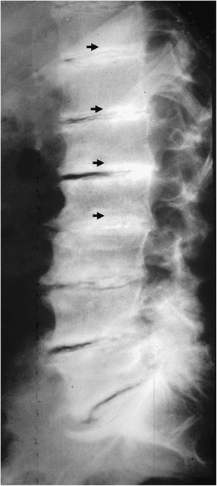 **Imaging Modality:** Lateral plain radiograph (X-ray).
**Anatomical Region:** Thoracolumbar spine.
**Observed Pathology:** Diffuse osteosclerosis with a characteristic "rugger-jersey spine" appearance, diagnostic of renal osteodystrophy (secondary hyperparathyroidism).
**Characteristic Visual Features:**
* **Distribution:** Multiple contiguous vertebral levels are affected.
* **Sclerotic Bands:** Prominent, horizontal radiopaque (dense) bands are visible along the superior and inferior endplates of the vertebral bodies.
* **Central Lucency:** The mid-portion of each vertebral body remains relatively radiolucent compared to the thickened endplates, creating a striped or "sandwich" appearance.
* **Associated Findings:** There is a generalized increase in bone density (osteosclerosis) throughout the visualized axial skeleton. Black arrows highlight the specific sub-endplate densities.
**Clinical Context:** This manifestation is typically seen in patients with chronic kidney disease (CKD) and end-stage renal disease undergoing long-term hemodialysis.
**Key Diagnostic Features:** The alternating pattern of dense sclerotic endplates and lucent vertebral centers is the pathognomonic sign of the rugger-jersey spine, distinguishing it from other causes of diffuse osteosclerosis like osteopetrosis or Paget's disease.