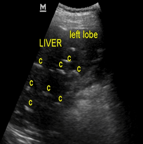 **Imaging Modality:** Abdominal Ultrasound (B-mode)
**Anatomical Region:** Upper abdomen, specifically the left lobe of the liver.
**Observed Pathology:** Multiple intrahepatic calcifications (labeled 'C').
**Characteristic Visual Features:**
The image demonstrates a heterogeneous liver parenchyma containing numerous discrete, brightly hyperechoic foci. These lesions exhibit a linear or curvilinear morphology and are associated with distinct posterior acoustic shadowing, indicating a high-density, calcified composition. The distribution of these calcifications is multifocal and results in a visible distortion of the normal, fine-grained homogeneous echo texture of the hepatic architecture. No discrete cystic components or solid masses are visible in the immediate field of view.
**Key Diagnostic Features:**
- **Hyperechoic foci:** High-amplitude reflections consistent with mineralized deposits.
- **Posterior acoustic shadowing:** Pathognomonic feature of calcification or gallstones, where the ultrasound beam is absorbed or reflected, creating a dark void deep to the lesion.
- **Parenchymal distortion:** Evidence of chronic or extensive involvement affecting the organ's structural integrity.
**Clinical Context:** These findings are consistent with sequelae of chronic infections (e.g., granulomatous disease), hepatolithiasis, or parasitic infestations such as calcified hydatid cysts or schistosomiasis.