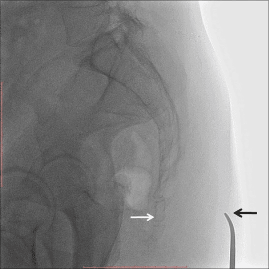 **Imaging Modality:** Lateral fluoroscopy (X-ray).
**Anatomical Region:** Lower pelvic region, specifically the sacrum and coccyx.
**Key Landmarks and Findings:**
- The image displays a lateral profile of the sacral curvature transitioning into the coccygeal segments.
- A **white arrow** points to the **sacrococcygeal joint**, the articulation between the apex of the sacrum and the base of the coccyx.
- A **black arrow** indicates a radiopaque external pointer (medical instrument) positioned on the skin surface, serving as a fiduciary marker to correlate superficial anatomy with internal osseous structures.
- The distal sacral segments and the individual segments of the coccyx are visible, showing normal alignment in this view.
**Clinical Context:** This imaging is characteristic of procedural localization, likely for a sacrococcygeal nerve block, ganglion impar block, or diagnostic evaluation of coccydynia. The use of a surface pointer ensures accurate needle entry trajectory relative to the target joint space.
**Search Keywords:** Lateral fluoroscopy, sacrococcygeal joint, coccyx, sacrum, ganglion impar block, procedural localization, radiopaque marker.