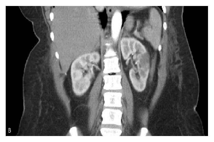 **Imaging Modality:** Contrast-enhanced Computed Tomography (CT).
**Anatomical Region:** Abdomen, coronal reformatted view.
**Key Landmarks:** Bilateral kidneys, liver, spleen, abdominal aorta, and lumbar spine.
**Observed Pathology:**
The image demonstrates a localized, wedge-shaped area of hypoenhancement within the renal parenchyma. This focal perfusion defect is situated in the mid-to-lower pole of the right kidney.
**Characteristic Visual Features:**
* **Morphology:** A well-demarcated, triangular (wedge-shaped) zone of low attenuation with the apex pointing toward the renal hilum and the base at the cortical surface.
* **Enhancement Pattern:** Significant lack of contrast uptake compared to the surrounding normally enhancing renal cortex and medulla.
* **Surrounding Structures:** The contralateral (left) kidney appears normally enhancing without similar perfusion defects. No gross evidence of perinephric fluid or hemorrhage is visualized in this plane.
**Diagnostic Features:**
The classic wedge-shaped hypoattenuation is highly characteristic of an acute renal infarct, indicating a localized vascular occlusion and subsequent segmental ischemia. The orientation and sharp margins help differentiate this from pyelonephritis or renal mass lesions.