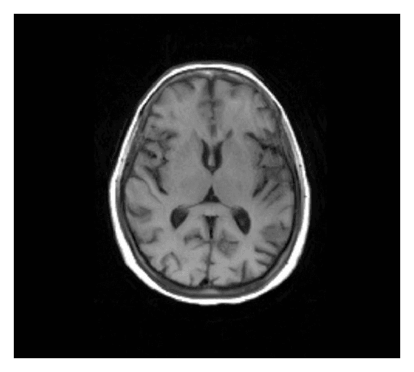 **Imaging Modality:** Magnetic Resonance Imaging (MRI); T1-weighted sequence.
**Anatomical Region:** Axial section of the brain at the level of the basal ganglia and thalamus.
**Key Landmarks:** Visible structures include the caudate nucleus, putamen, globus pallidus, and thalamus. The internal capsule (anterior and posterior limbs), the frontal horns of the lateral ventricles, and the third ventricle are well-defined.
**Observed Findings:** The image demonstrates normal neuroanatomical architecture. The basal ganglia structures exhibit typical T1-weighted signal intensity and morphology. There is clear differentiation between the gray matter and white matter (e.g., the hyperintense internal capsule relative to the surrounding deep gray nuclei). The ventricular system is non-dilated and midline, with no evidence of mass effect, midline shift, or focal signal abnormalities within the deep nuclei.
**Diagnostic Features:** Homogeneous signal across the lentiform nuclei and thalami bilaterally. Sulcal patterns and cortical thickness appear unremarkable for this slice level. This image serves as a baseline representation of normal intracranial anatomy on a T1-weighted axial MRI.