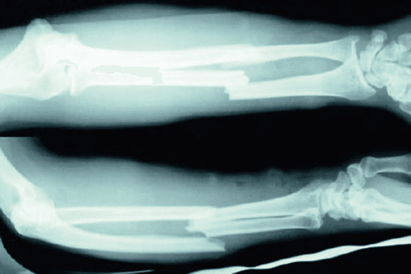 **Imaging Modality:** Conventional projectional radiography (X-ray).
**Anatomical Region:** Forearm (radius and ulna) including the elbow and wrist joints.
**Observed Pathology:** Displaced, mid-shaft fractures of both the radius and the ulna, commonly referred to as a "both-bone" forearm fracture.
**Characteristic Visual Features:**
- **Fracture Type:** Complete transverse or slightly oblique fractures involving the diaphysis of both bones.
- **Displacement:** Significant lateral and longitudinal displacement of the distal fracture fragments relative to the proximal segments.
- **Alignment:** Overlapping of the bony ends (shortening) is visible, with a loss of normal anatomical cortical continuity.
- **Joints:** The proximal radioulnar, humeroulnar, and distal radioulnar joints appear grossly intact in these views, though alignment is altered by the diaphyseal trauma.
- **Soft Tissue:** Associated soft tissue swelling is evident surrounding the fracture sites.
**Key Diagnostic Features:** Simultaneous diaphyseal disruption of the radius and ulna with significant malalignment, requiring surgical intervention for anatomical reduction and stabilization.